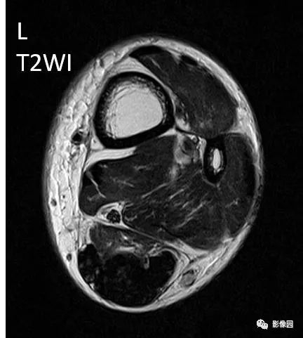 【病例】双侧跟腱多发结节性黄色瘤1例MR影像表现 【病例】双侧跟腱多发结节性黄色瘤1例MR影像表现