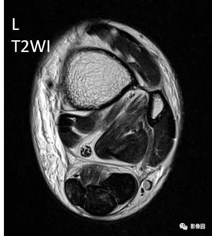 【病例】双侧跟腱多发结节性黄色瘤1例MR影像表现 【病例】双侧跟腱多发结节性黄色瘤1例MR影像表现