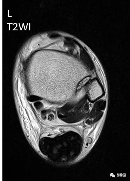 【病例】双侧跟腱多发结节性黄色瘤1例MR影像表现 【病例】双侧跟腱多发结节性黄色瘤1例MR影像表现