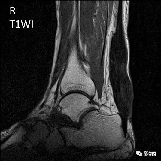 【病例】双侧跟腱多发结节性黄色瘤1例MR影像表现 【病例】双侧跟腱多发结节性黄色瘤1例MR影像表现