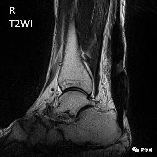 【病例】双侧跟腱多发结节性黄色瘤1例MR影像表现 【病例】双侧跟腱多发结节性黄色瘤1例MR影像表现