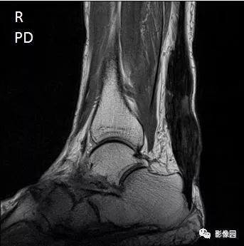 【病例】双侧跟腱多发结节性黄色瘤1例MR影像表现 【病例】双侧跟腱多发结节性黄色瘤1例MR影像表现