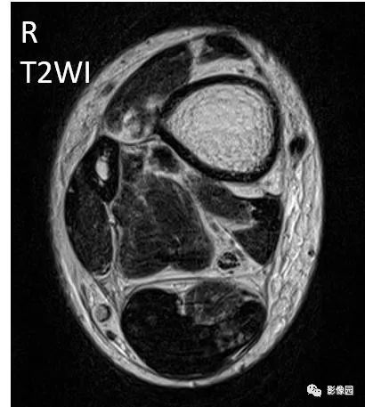 【病例】双侧跟腱多发结节性黄色瘤1例MR影像表现 【病例】双侧跟腱多发结节性黄色瘤1例MR影像表现
