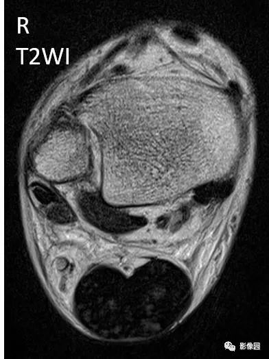 【病例】双侧跟腱多发结节性黄色瘤1例MR影像表现 【病例】双侧跟腱多发结节性黄色瘤1例MR影像表现