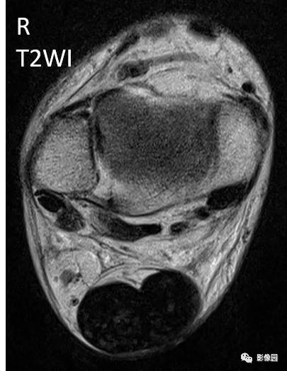 【病例】双侧跟腱多发结节性黄色瘤1例MR影像表现 【病例】双侧跟腱多发结节性黄色瘤1例MR影像表现