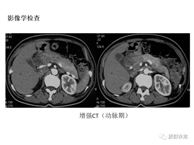 【病例】胰腺神经内分泌肿瘤1例