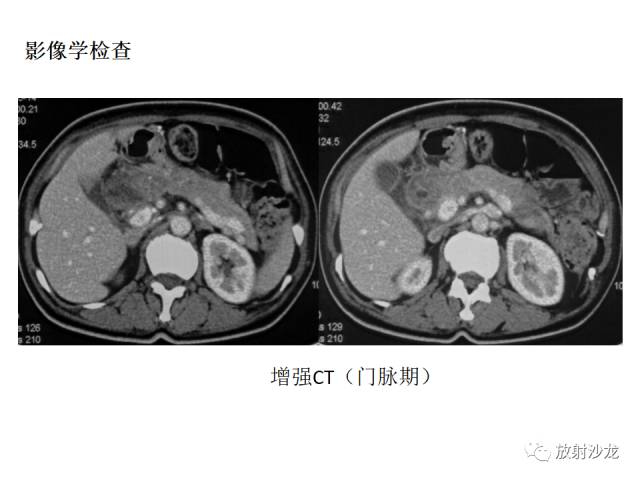 【病例】胰腺神经内分泌肿瘤1例