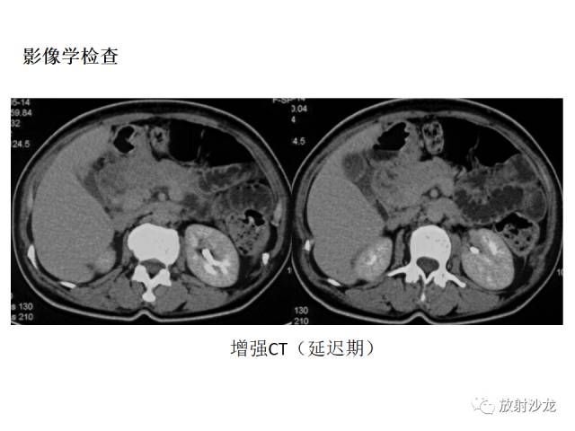 【病例】胰腺神经内分泌肿瘤1例