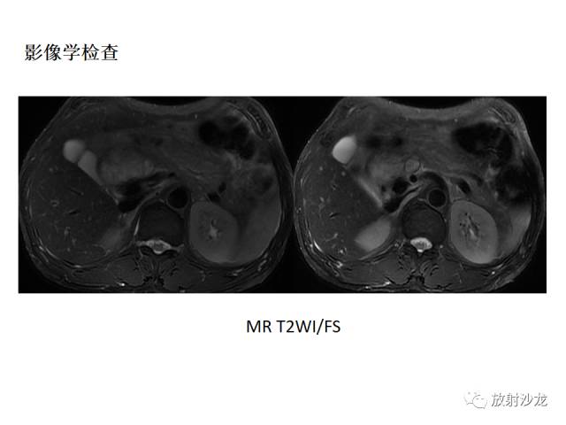 【病例】胰腺神经内分泌肿瘤1例