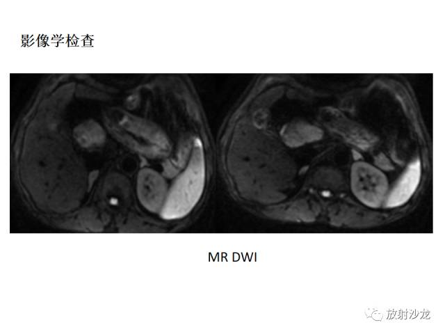 【病例】胰腺神经内分泌肿瘤1例