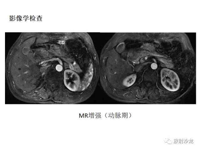 【病例】胰腺神经内分泌肿瘤1例