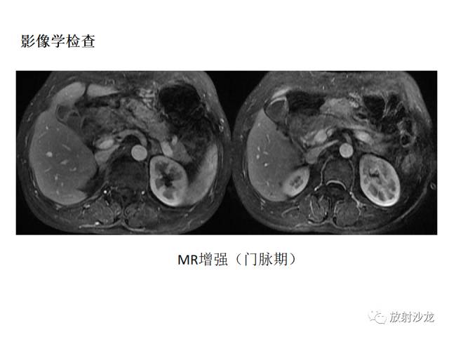 【病例】胰腺神经内分泌肿瘤1例
