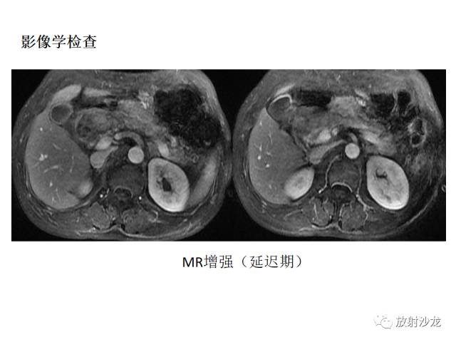 【病例】胰腺神经内分泌肿瘤1例
