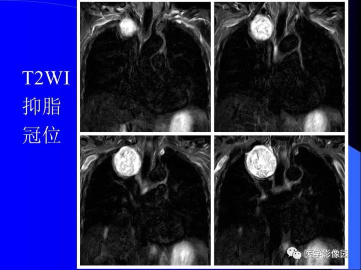 【病例】后纵隔神经鞘瘤1例CT及MR影像表现