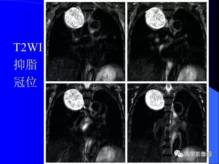 【病例】后纵隔神经鞘瘤1例CT及MR影像表现