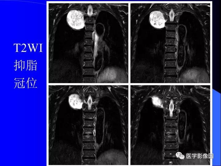 【病例】后纵隔神经鞘瘤1例CT及MR影像表现