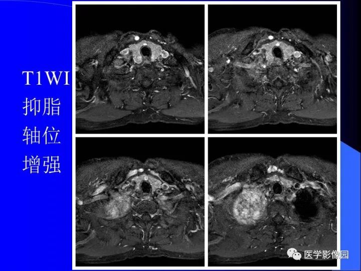 【病例】后纵隔神经鞘瘤1例CT及MR影像表现