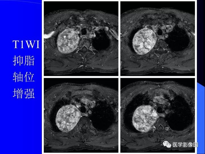 【病例】后纵隔神经鞘瘤1例CT及MR影像表现