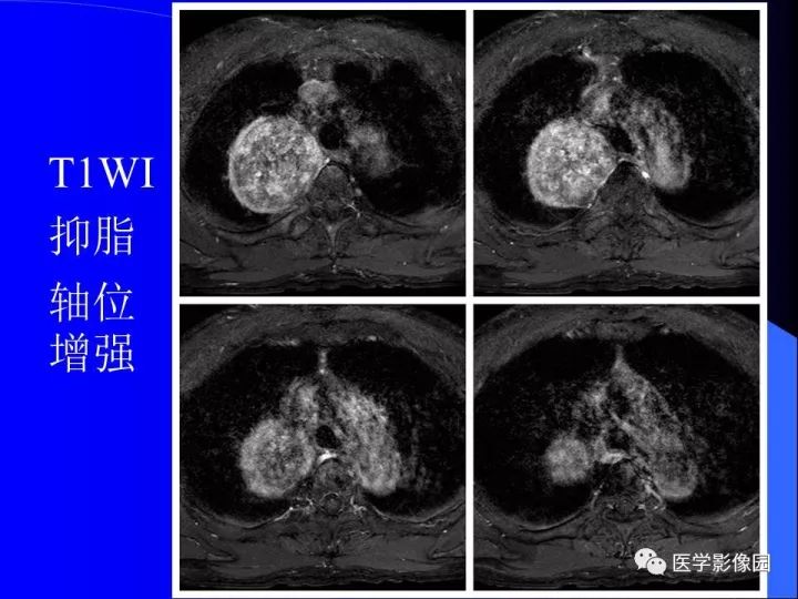 【病例】后纵隔神经鞘瘤1例CT及MR影像表现