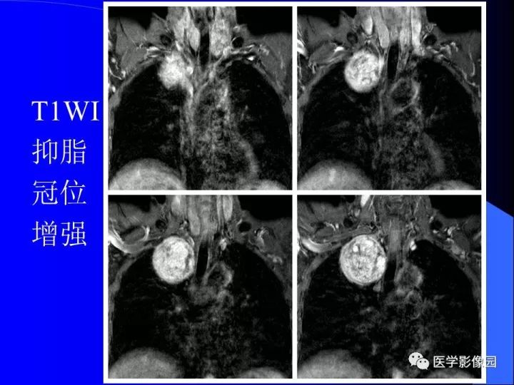 【病例】后纵隔神经鞘瘤1例CT及MR影像表现