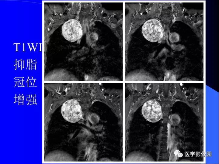 【病例】后纵隔神经鞘瘤1例CT及MR影像表现