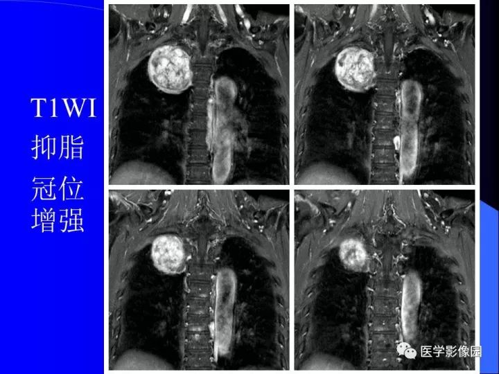 【病例】后纵隔神经鞘瘤1例CT及MR影像表现