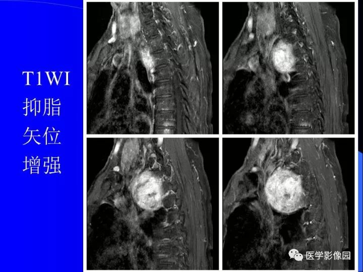 【病例】后纵隔神经鞘瘤1例CT及MR影像表现