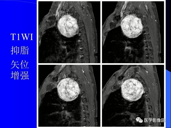【病例】后纵隔神经鞘瘤1例CT及MR影像表现