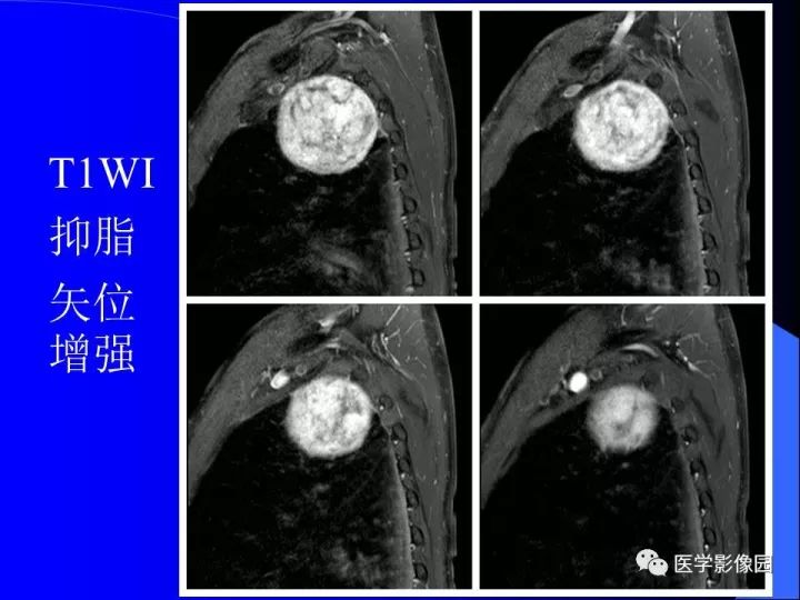 【病例】后纵隔神经鞘瘤1例CT及MR影像表现