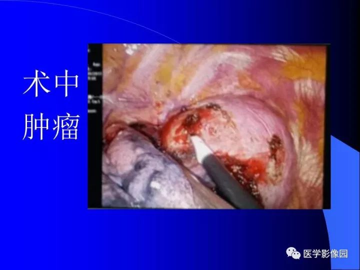 【病例】后纵隔神经鞘瘤1例CT及MR影像表现