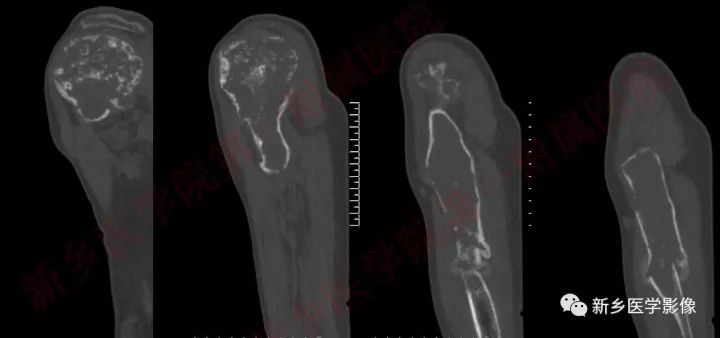 【病例】左侧肱骨软骨肉瘤1例X线CT影像表现 【病例】左侧肱骨软骨肉瘤1例X线CT影像表现