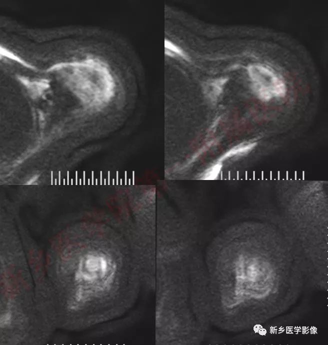 【病例】左侧肱骨软骨肉瘤1例X线CT影像表现 【病例】左侧肱骨软骨肉瘤1例X线CT影像表现