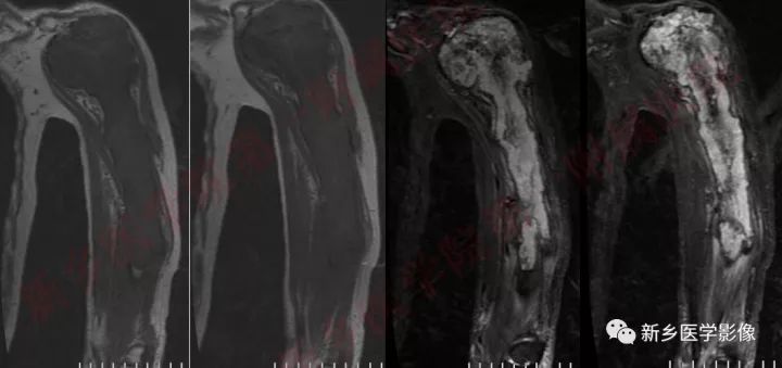 【病例】左侧肱骨软骨肉瘤1例X线CT影像表现 【病例】左侧肱骨软骨肉瘤1例X线CT影像表现