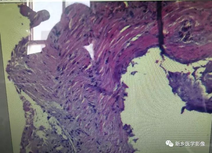 【病例】左侧肱骨软骨肉瘤1例X线CT影像表现 【病例】左侧肱骨软骨肉瘤1例X线CT影像表现