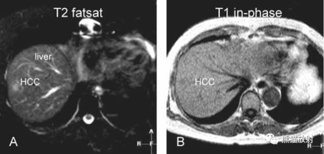 肝硬化之肝细胞癌(HCC):典型小肝癌、肿瘤包膜MRI表现与病理相关性 肝硬化之肝细胞癌(HCC):典型小肝癌、肿瘤包膜MRI表现与病理相关性