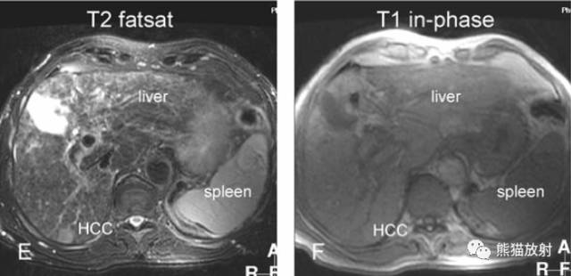 肝硬化之肝细胞癌(HCC):典型小肝癌、肿瘤包膜MRI表现与病理相关性 肝硬化之肝细胞癌(HCC):典型小肝癌、肿瘤包膜MRI表现与病理相关性