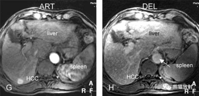 肝硬化之肝细胞癌(HCC):典型小肝癌、肿瘤包膜MRI表现与病理相关性 肝硬化之肝细胞癌(HCC):典型小肝癌、肿瘤包膜MRI表现与病理相关性