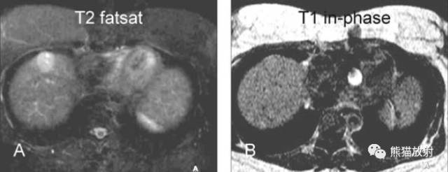 肝硬化之肝细胞癌(HCC):典型小肝癌、肿瘤包膜MRI表现与病理相关性 肝硬化之肝细胞癌(HCC):典型小肝癌、肿瘤包膜MRI表现与病理相关性