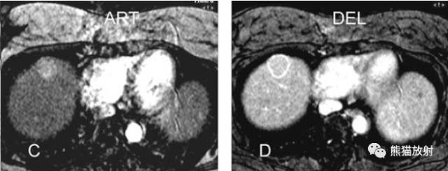 肝硬化之肝细胞癌(HCC):典型小肝癌、肿瘤包膜MRI表现与病理相关性 肝硬化之肝细胞癌(HCC):典型小肝癌、肿瘤包膜MRI表现与病理相关性