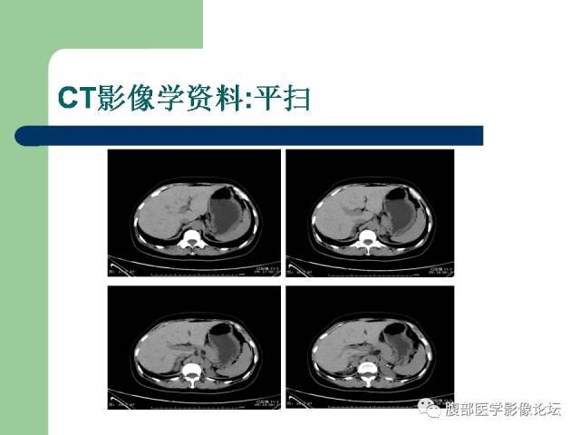【病例】双侧肾上腺嗜铬细胞瘤1例CT及MR影像表现