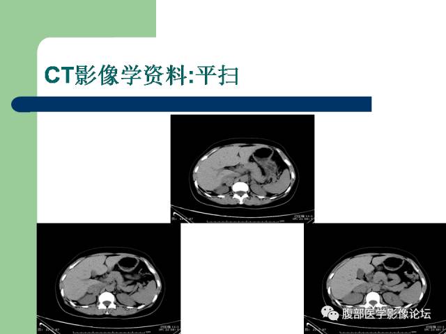 【病例】双侧肾上腺嗜铬细胞瘤1例CT及MR影像表现