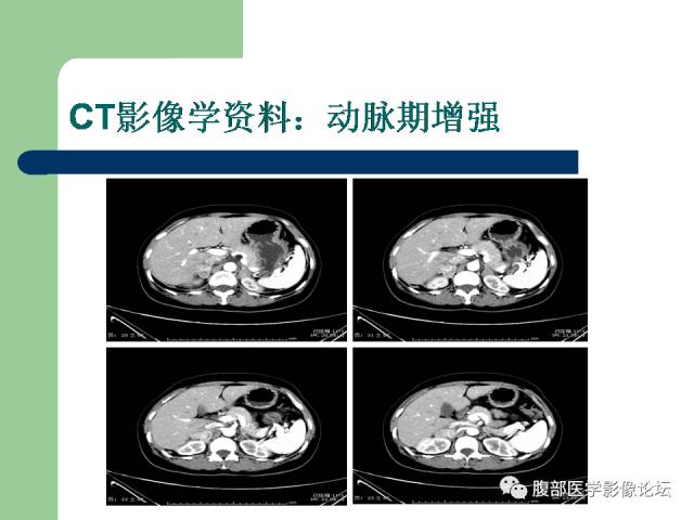 【病例】双侧肾上腺嗜铬细胞瘤1例CT及MR影像表现