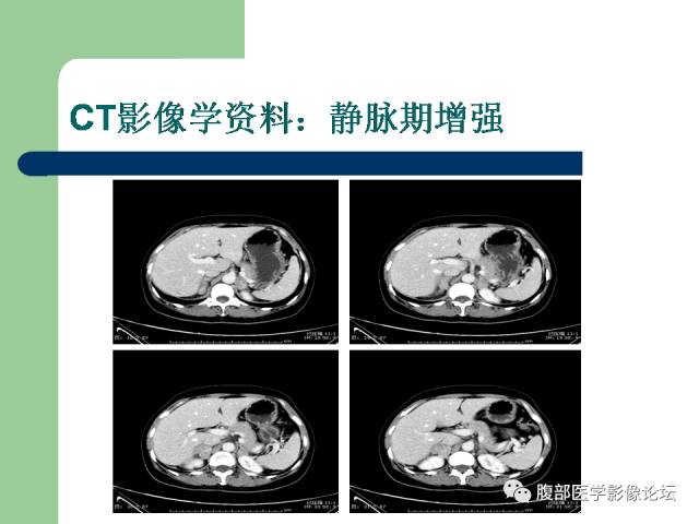 【病例】双侧肾上腺嗜铬细胞瘤1例CT及MR影像表现