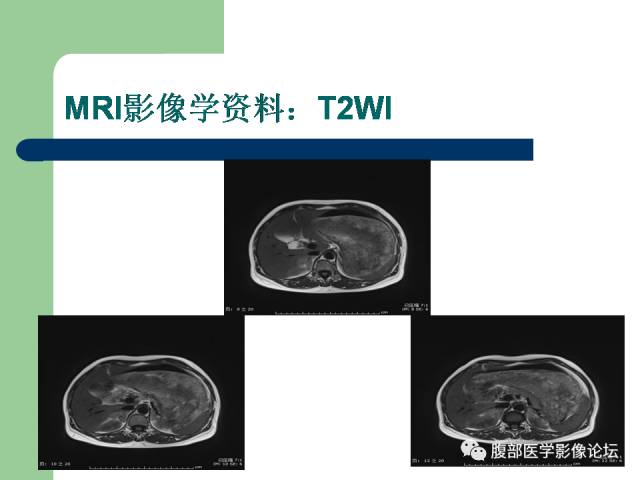 【病例】双侧肾上腺嗜铬细胞瘤1例CT及MR影像表现