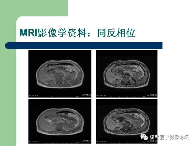 【病例】双侧肾上腺嗜铬细胞瘤1例CT及MR影像表现