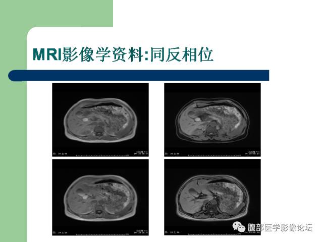 【病例】双侧肾上腺嗜铬细胞瘤1例CT及MR影像表现