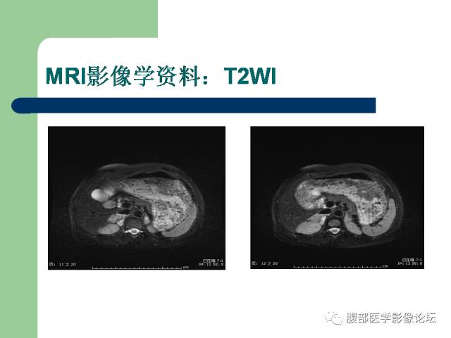 【病例】双侧肾上腺嗜铬细胞瘤1例CT及MR影像表现