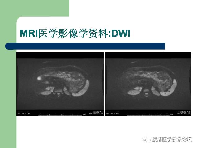 【病例】双侧肾上腺嗜铬细胞瘤1例CT及MR影像表现