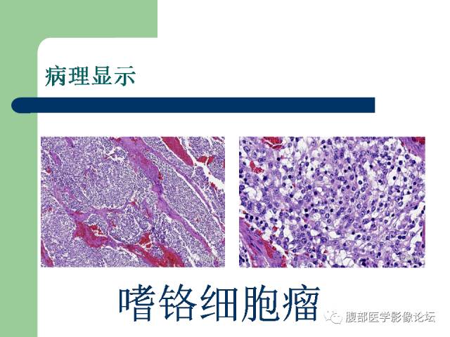 【病例】双侧肾上腺嗜铬细胞瘤1例CT及MR影像表现