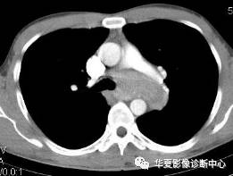 【病例】纵隔巨淋巴结增生症1例CT影像表现 【病例】纵隔巨淋巴结增生症1例CT影像表现